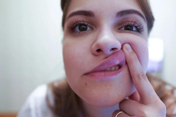 
        Распространен и очень опасен. Названы проблемы со здоровьем от стоматита    