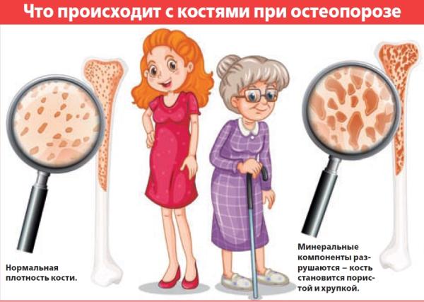 Почти хрустальные. Причины остеопороза у детей и подростков
Почти хрустальные. Причины остеопороза у детей и подростков